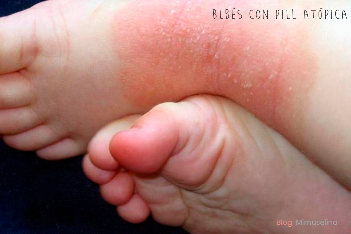 bebes con piel atópica cuidados dermatitits